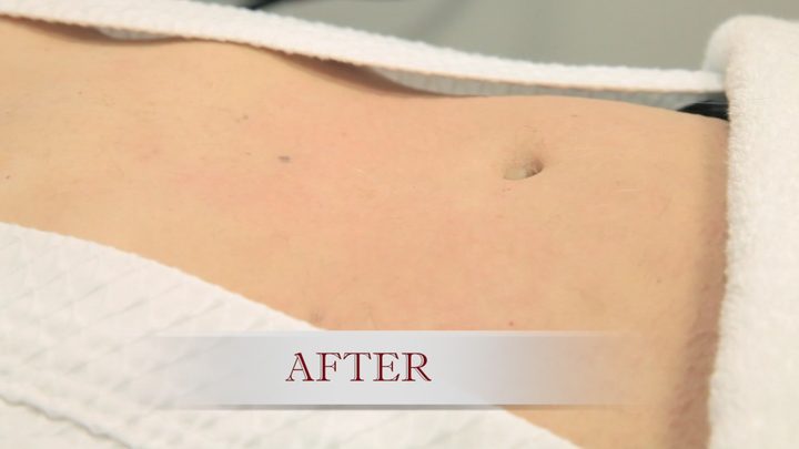 After laser hair removal: the same area of the abdomen