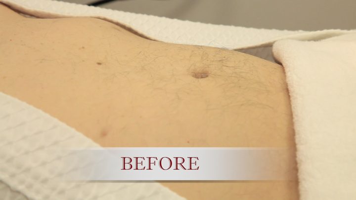 Before laser hair removal: hair on a client's abdomen